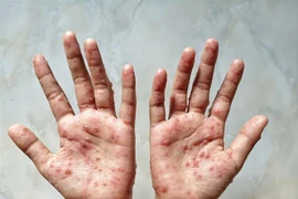 Cambodia logs 12 cases of monkeypox